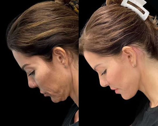 Deep Plane Facelift Before After () Deep Plane Facelift Before After ()
