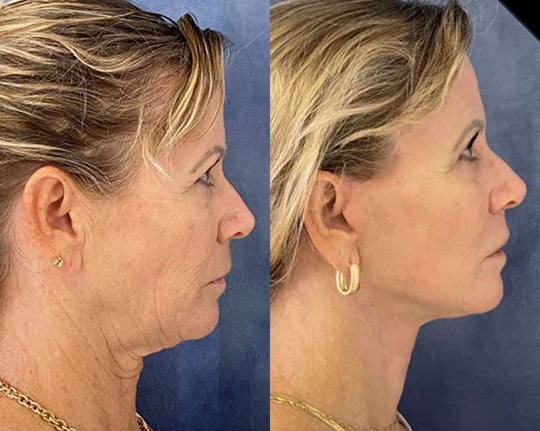 Deep Plane Facelift Before After Deep Plane Facelift Before After