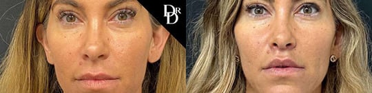 Lift Lip Before And After Lift Lip Before And After