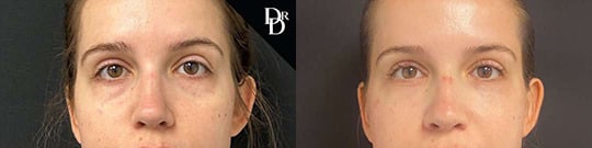 Lower Eyelid With Fat Grafting Before And After Lower Eyelid With Fat Grafting Before And After