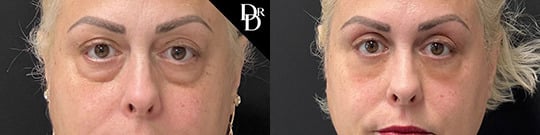 Lower Eyelid With Fat Grafting Before And After Lower Eyelid With Fat Grafting Before And After