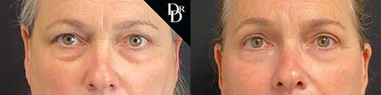Lower Eyelid With Fat Grafting Before And After Lower Eyelid With Fat Grafting Before And After