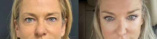 Upper Eyelid Lift Before And After Upper Eyelid Lift Before And After