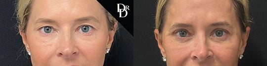 Upper Eyelid Lift Before And After Upper Eyelid Lift Before And After
