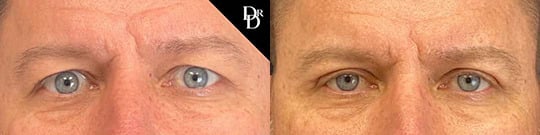 Upper Eyelid Lift Before And After Jpg Upper Eyelid Lift Before And After Jpg
