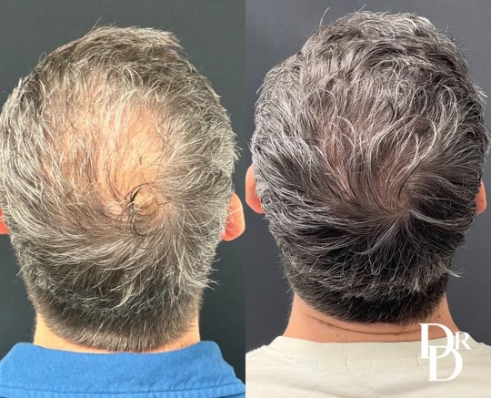 Hair Transplant Before And After Photo By Dr. Demetri In Beverly Hills California