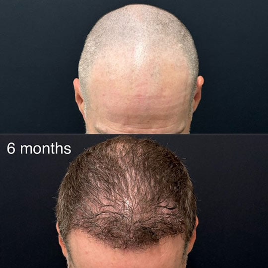 Hair Transplant Before And After Photos By Dr. Demetri Arnaoutakis In Tampa, Fl
