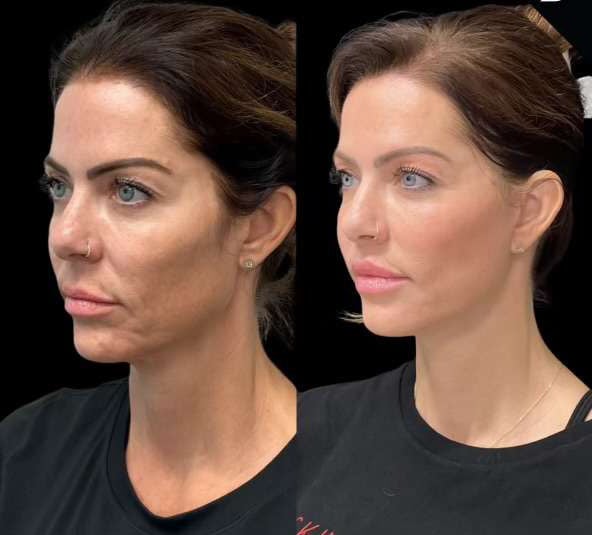 Facelift Before And After Photos By Dr. Demetri Arnaoutakis In Tampa, Fl