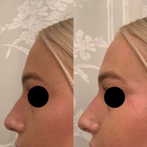 Liquid Rhinoplasty Before And After Photos By Dr. Demetri Arnaoutakis In Tampa, Fl