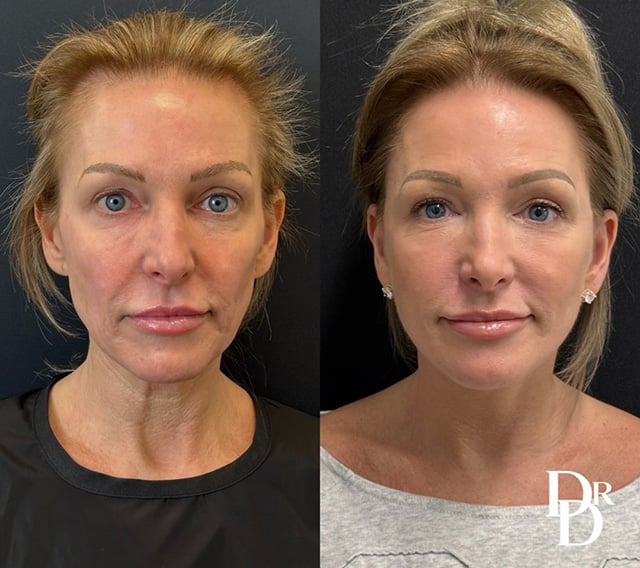 Facelift Before And After Photo By Dr. Demetri In Beverly Hills, Ca