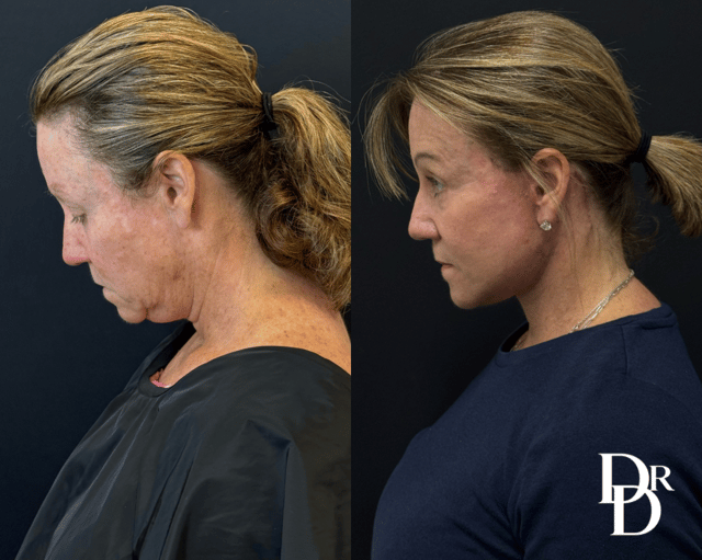 Facelift Before And After Photos By Dr. Demetri Arnaoutakis In Tampa, Fl