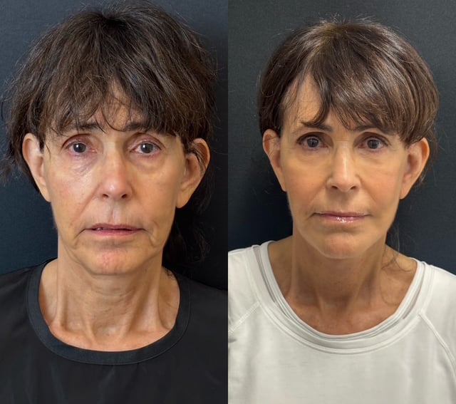 Facelift And Lower Blepharoplasty Before And After Photos By Dr. Demetri Arnaoutakis In Tampa, Fl
