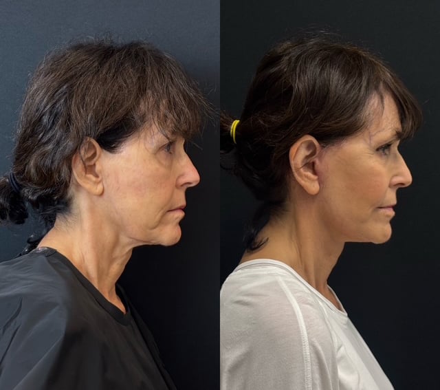 Facelift And Lower Blepharoplasty Before And After Photos By Dr. Demetri Arnaoutakis In Tampa, Fl