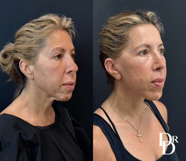 Facelift Before And After Photos By Dr. Demetri Arnaoutakis In Tampa, Fl
