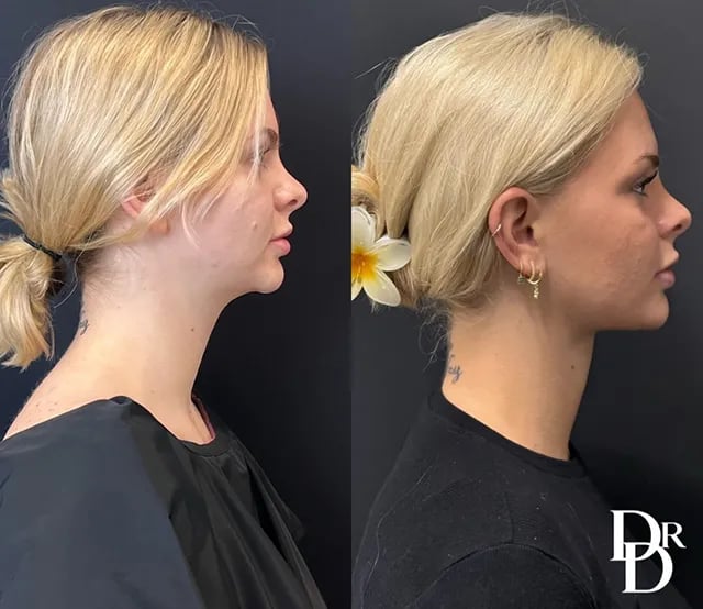 Neck Lift &Amp; Liposuction Before And After Photos By Dr. Demetri Arnaoutakis In Tampa, Fl