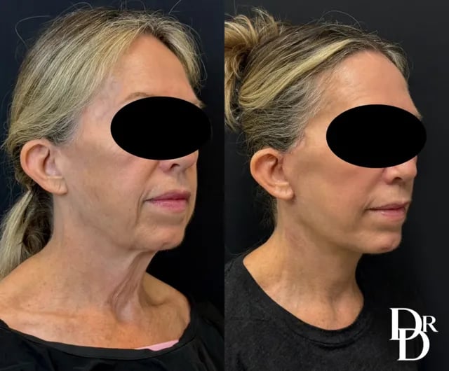 Right Oblique View Facelift Before And After Photos By Dr. Demetri Arnaoutakis In Tampa, Fl