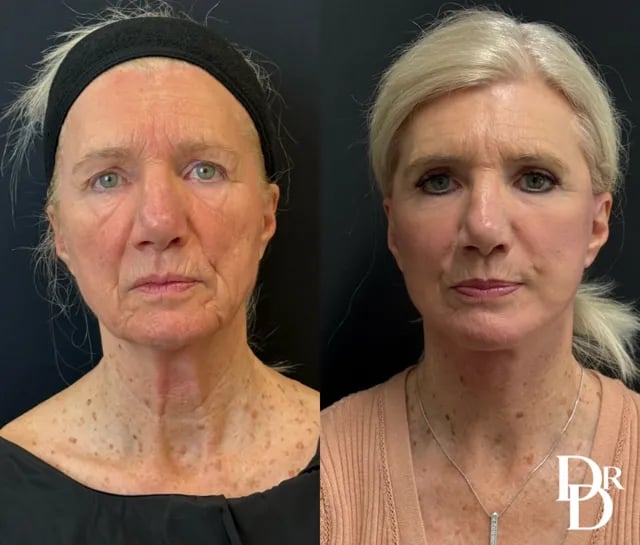 Front View Brow Lift Before And After Photos By Dr. Demetri Arnaoutakis In Tampa, Fl