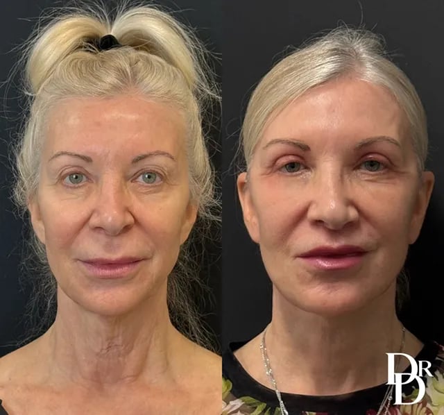 Front View Facelift Before And After Photos By Dr. Demetri Arnaoutakis In Tampa, Fl