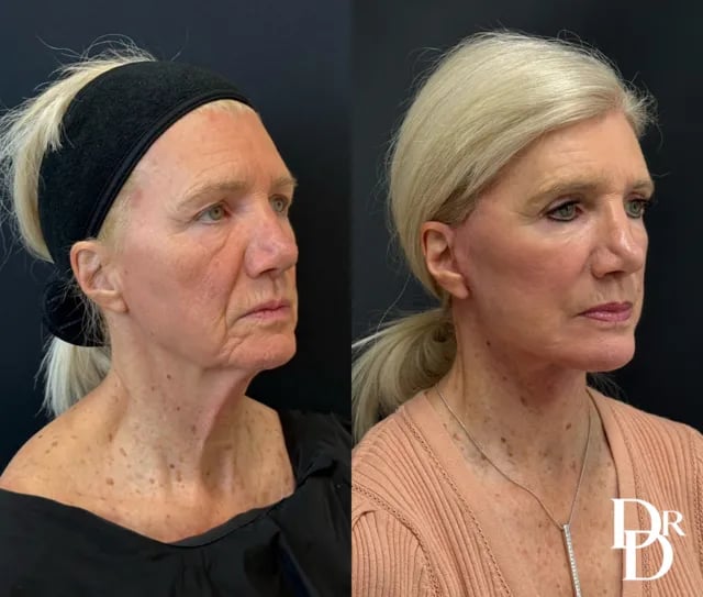 Right Oblique View Facelift Before And After Photos By Dr. Demetri Arnaoutakis In Tampa, Fl