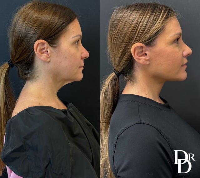 Right Side View Facelift And Neck Lift Before And After Photos By Dr. Demetri