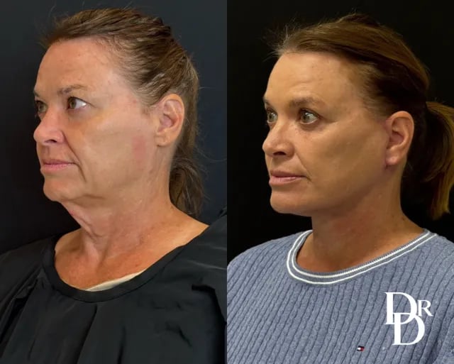 Left Oblique View Facelift Before And After Photos By Dr. Demetri