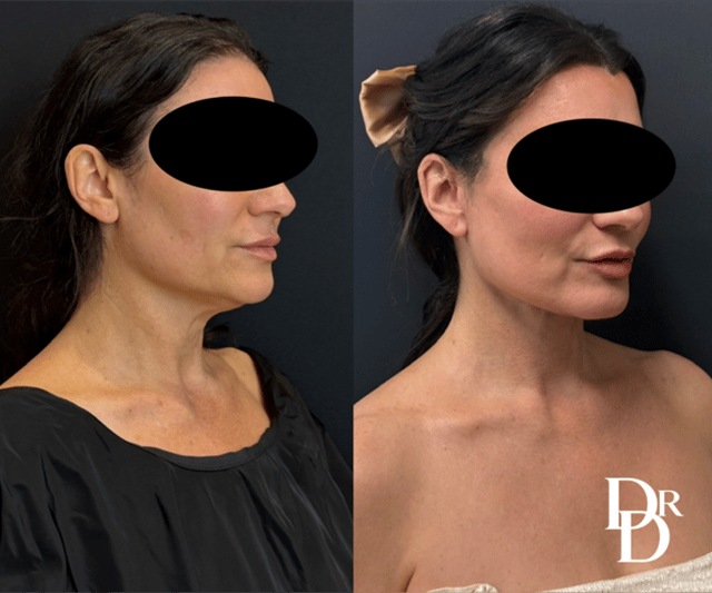 Right Oblique View Face And Neck Lift Before And After Photos By Dr. Demetri