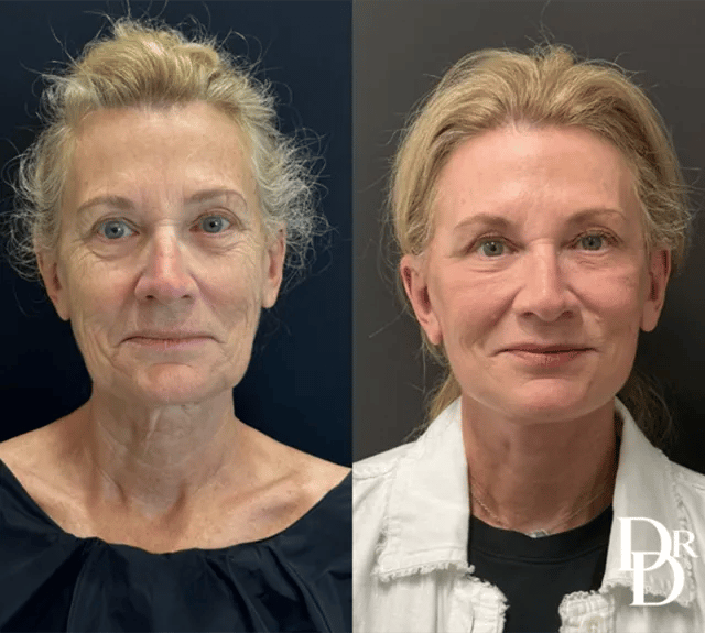 Front View Facelift Before And After Photo By Dr. Demetri