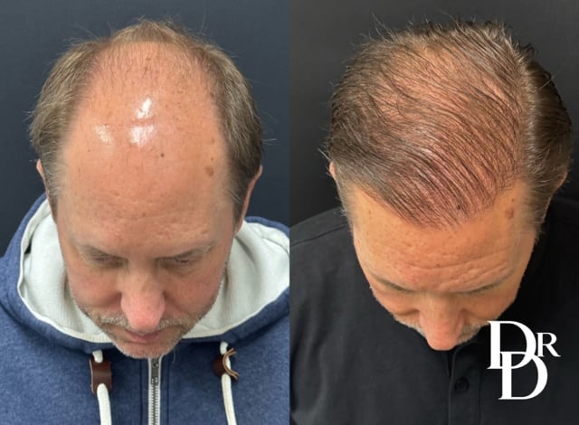 Close Up View Hair Transplant Before And After Photo By Dr. Demetri