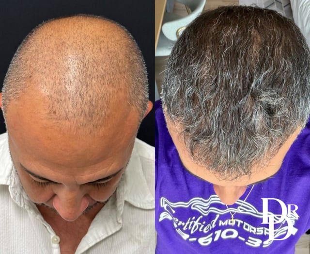 Head Down View Hair Transplant Before And After Photo By Dr. Demetri