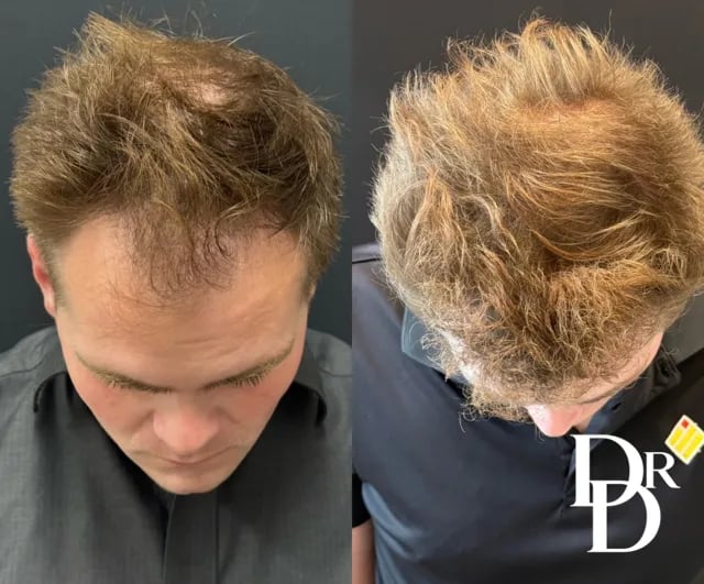 Head Down View Hair Transplant Before And After Photo By Dr. Demetri