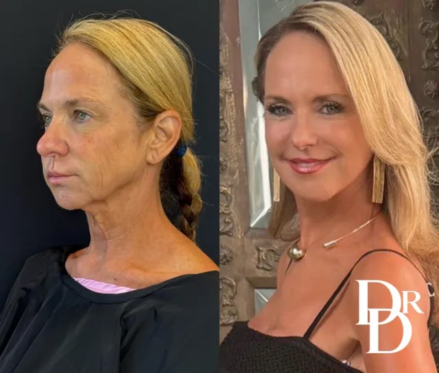 Left Oblique View Facelift Before And After Photo By Dr. Demetri
