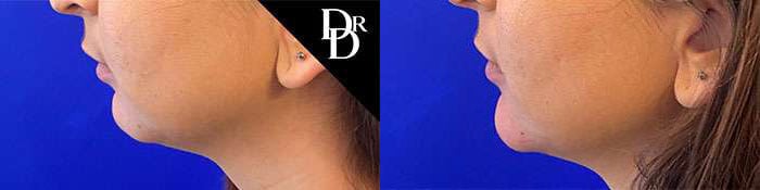 Chin Augmentation Before And After Photos By Dr. Demetri Arnaoutakis In Tampa, Fl