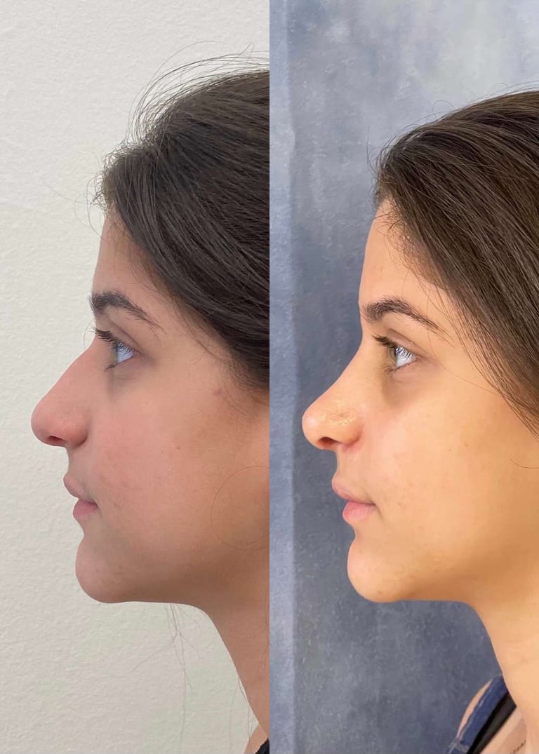 Rhinoplasty Before And After Photos By Dr. Demetri Arnaoutakis In Tampa, Fl Rhinoplasty Before And After Photos By Dr. Demetri Arnaoutakis In Tampa, Fl