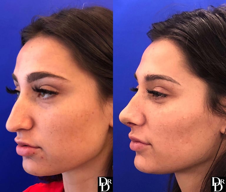 Rhinoplasty Before And After Photos By Dr. Demetri Arnaoutakis In Tampa, Fl Rhinoplasty Before And After Photos By Dr. Demetri Arnaoutakis In Tampa, Fl
