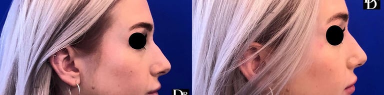Rhinoplasty Before And After Photos By Dr. Demetri Arnaoutakis In Tampa, Fl Rhinoplasty Before And After Photos By Dr. Demetri Arnaoutakis In Tampa, Fl