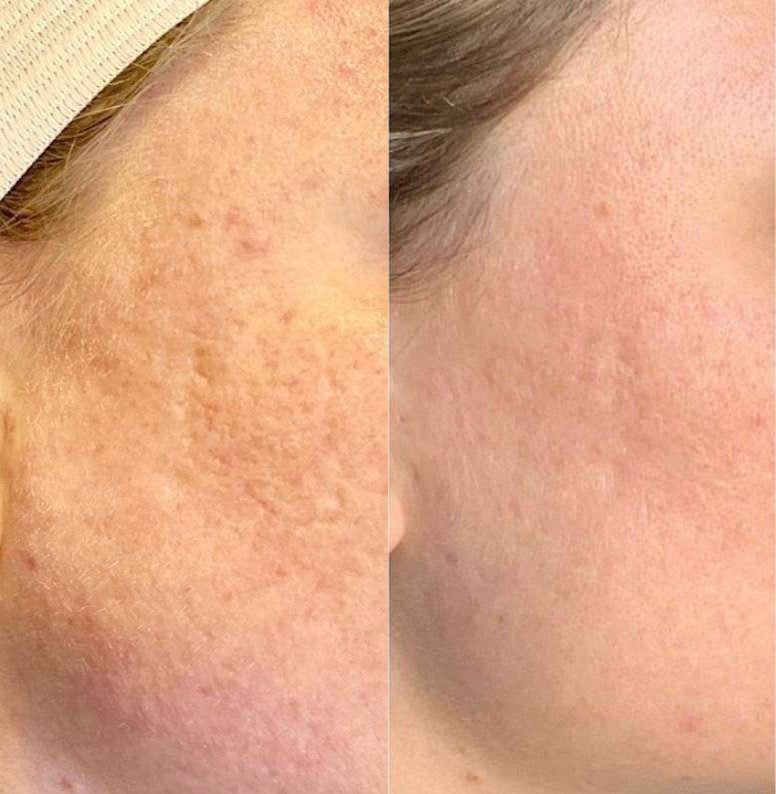 Microneedling Before And After Photos By Dr. Demetri Arnaoutakis In Tampa, Fl
