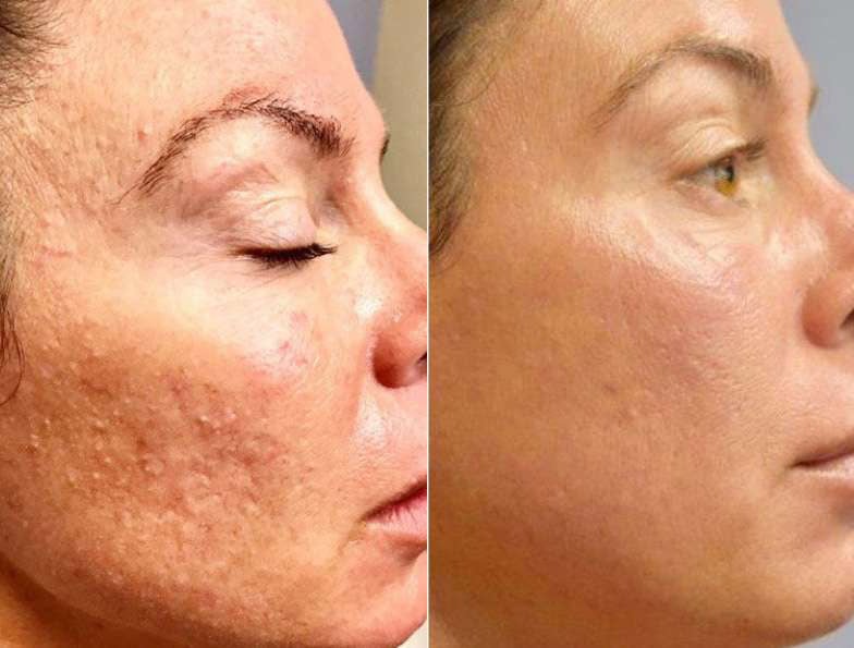 Microneedling Before And After Photos By Dr. Demetri Arnaoutakis In Tampa, Fl