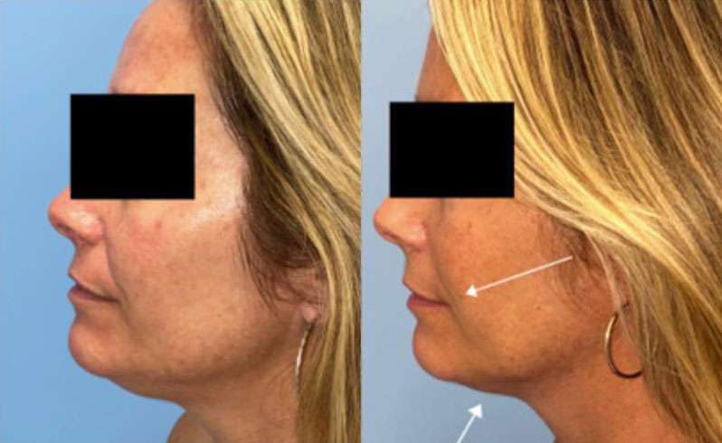 Sofwave Before And After Photos By Dr. Demetri Arnaoutakis In Tampa, Fl
