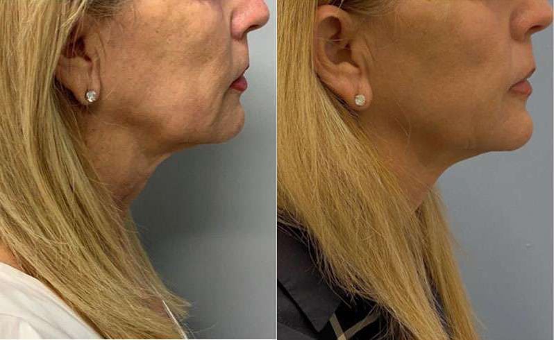 Sofwave Before And After Photos By Dr. Demetri Arnaoutakis In Tampa, Fl