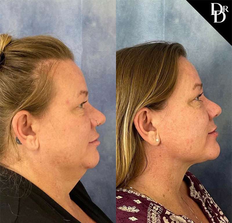 Facetite Before And After Photos By Dr. Demetri Arnaoutakis In Tampa, Fl