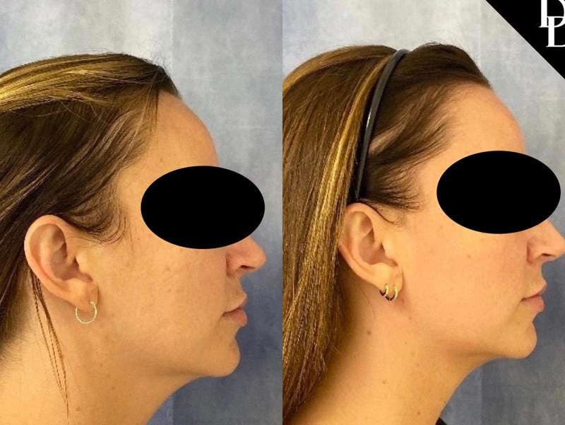 Facetite Before And After Photos By Dr. Demetri Arnaoutakis In Tampa, Fl