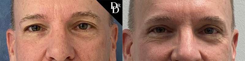 Eyelid Surgery Before And After Photos By Dr. Demetri Arnaoutakis In Tampa, Fl