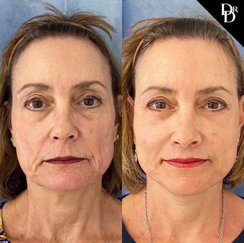 Lip Lift Before And After Photos By Dr. Demetri Arnaoutakis In Tampa, Fl