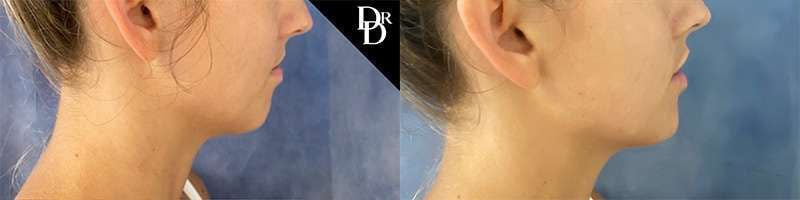 Chin Augmentation Before And After Photos By Dr. Demetri Arnaoutakis In Tampa, Fl