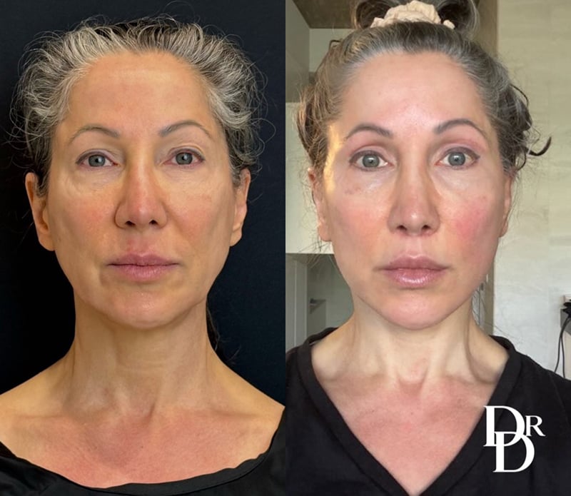 Front View Facelift Before And After Photos By Dr. Demetri