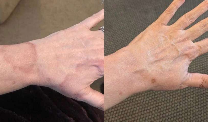 Microneedling Before And After Photos By Dr. Demetri Arnaoutakis In Tampa, Fl