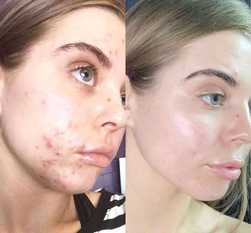 Chemical Peels Before And After Photos By Dr. Demetri Arnaoutakis In Tampa, Fl