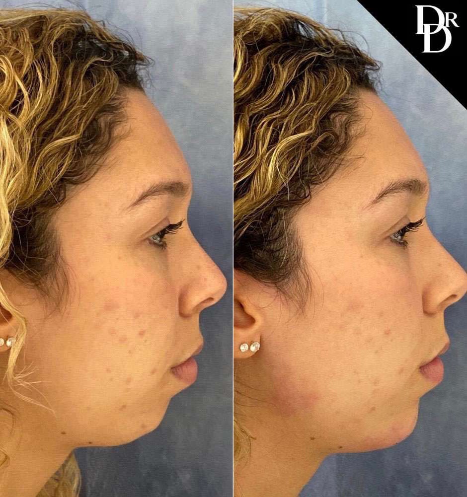 Chin Augmentation Before And After Photos By Dr. Demetri Arnaoutakis In Tampa, Fl